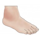 Ankle Strain
