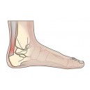 Achilles' Tendonitis 