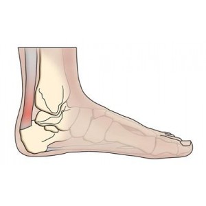 Achilles' Tendonitis 