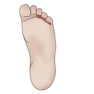 Athlete's Foot