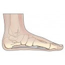 Arch Pain