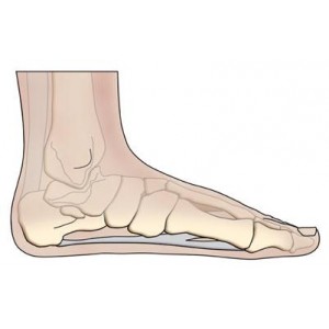 Flat Feet (Plantar Fasciitis)