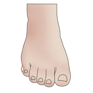 Blisters