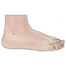 Hammer Toe