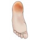 Dry Skin
