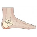 Heel Pain