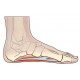 Plantar Fasciitis and Heel Spurs
