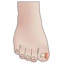 Ingrown Toenails