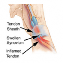 Conditions of the Thumb