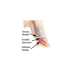 Conditions of the Thumb